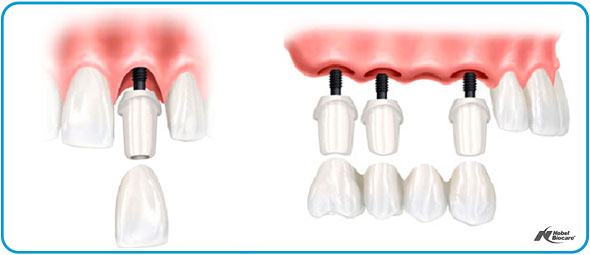 dentista-esseti-88-magenta-impianti-dentali-001