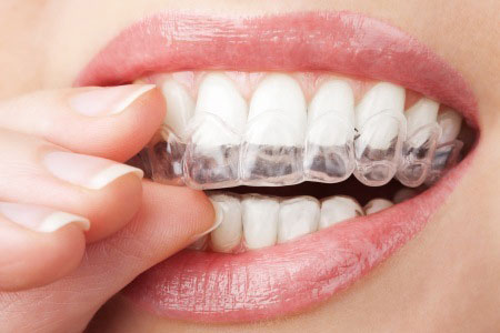 Dentista Invisalign Magenta studio dentistico Esseti 88