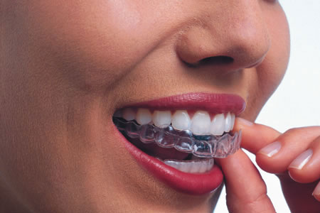 Dentista Invisalign Magenta studio dentistico Esseti 88